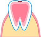C0 初期の虫歯