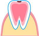 C1 表面のエナメル質の虫歯