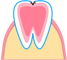 C2 象牙質まで達した虫歯