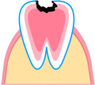 C3 歯髄(歯の神経)まで達した虫歯